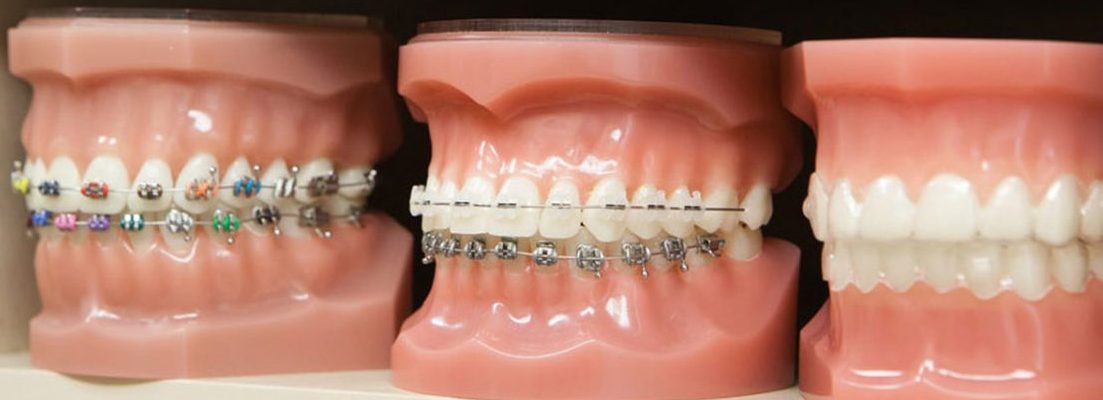 Dental Braces San Antonio | Affordable Orthodontics Texas | Orthodontics  San Antonio TX 78232