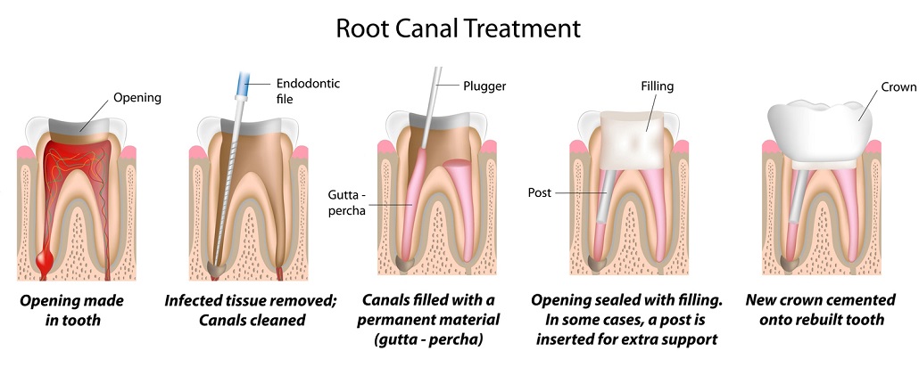Root Canal Treatment in San Antonio